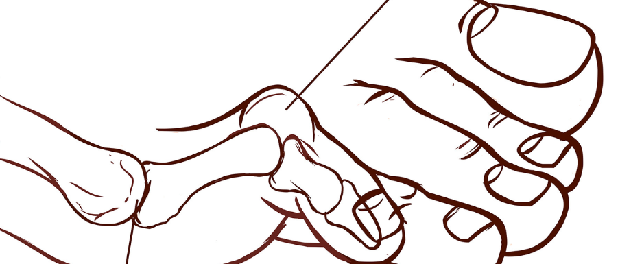 Diabetes and feet – Hammertoe Diagnosis